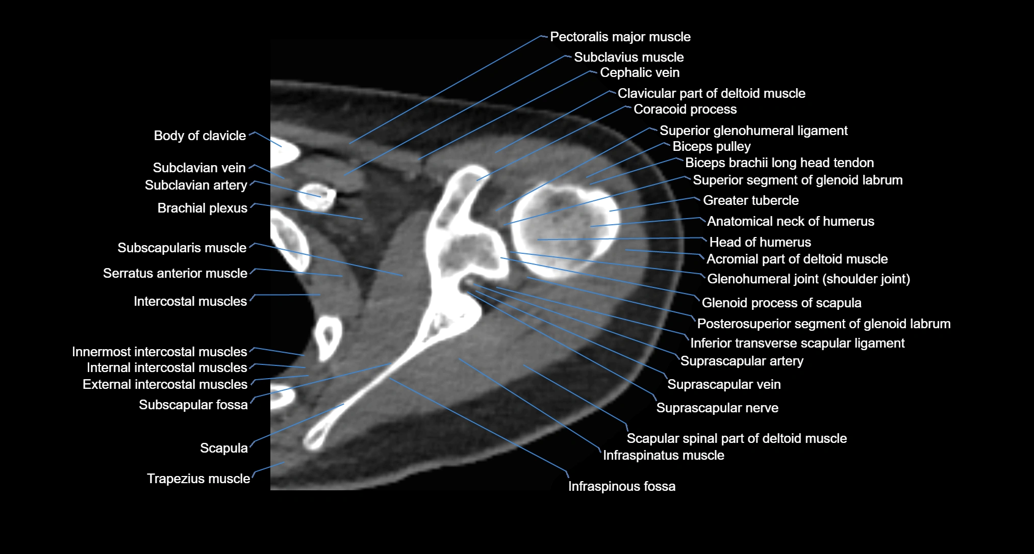 CT Shoulder axial cross sectional anatomy labelled radiology image -00026.webp